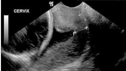 Cervical length assessments for the risk of preterm delivery